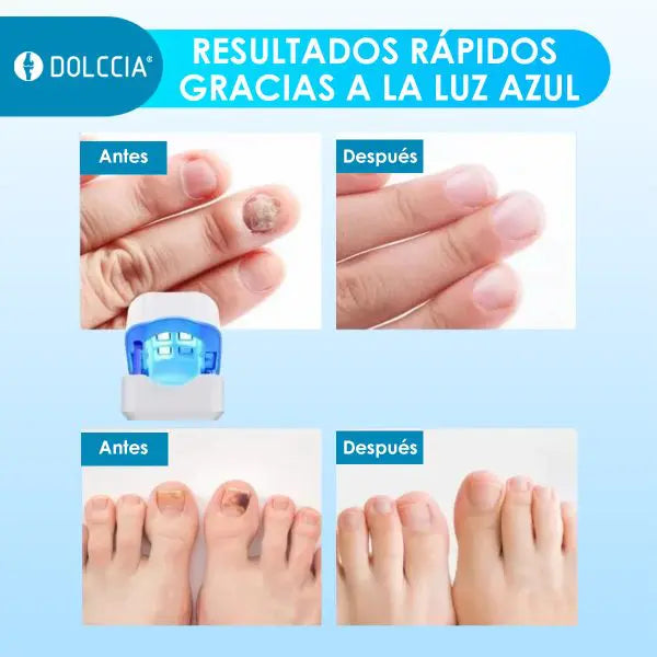 Laser Uñas del Pie Dolccia